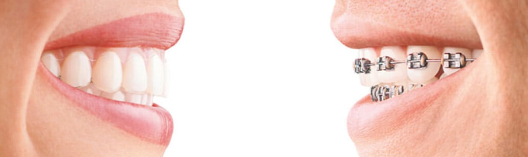 invisalign or braces