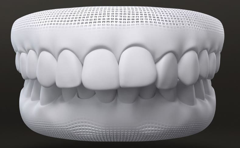 teeth crowding problem