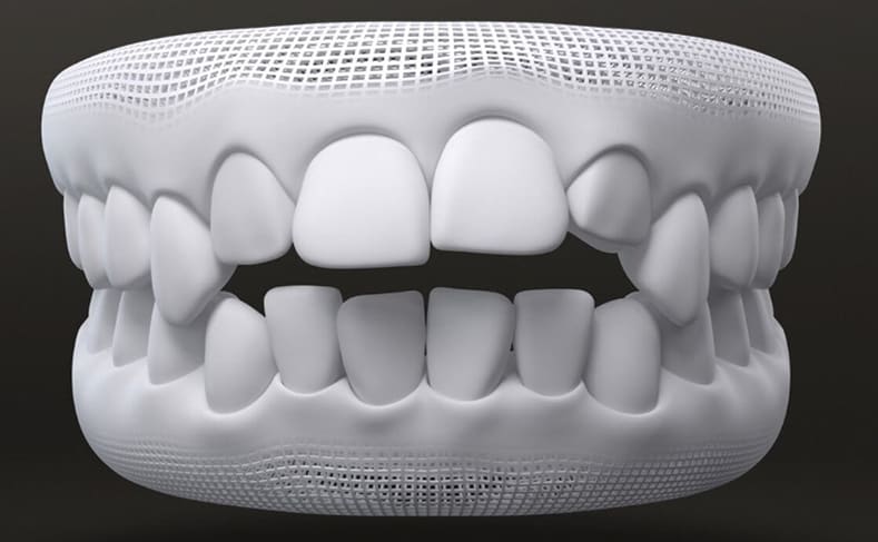teeth crowding problem