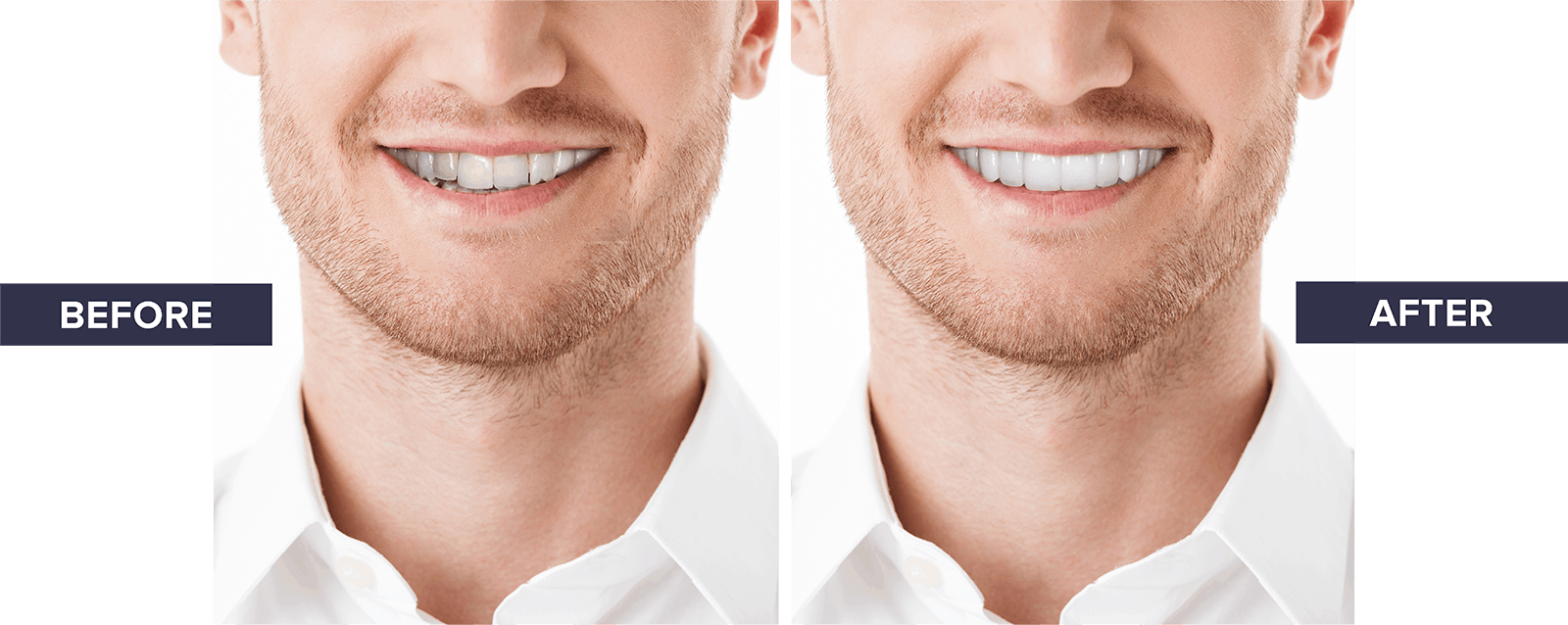 Veneers_Before_After-Etobicoke Veneers comparison after treatment
