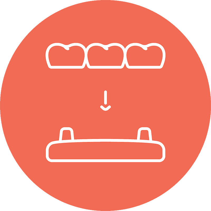 dental-bridges dental bridge