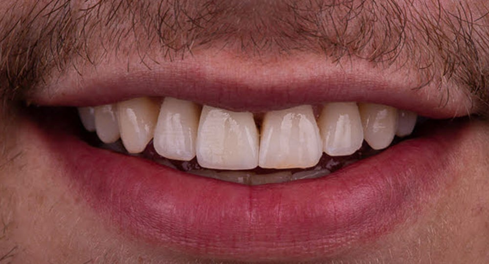 implants after Dental Implants Etobicoke