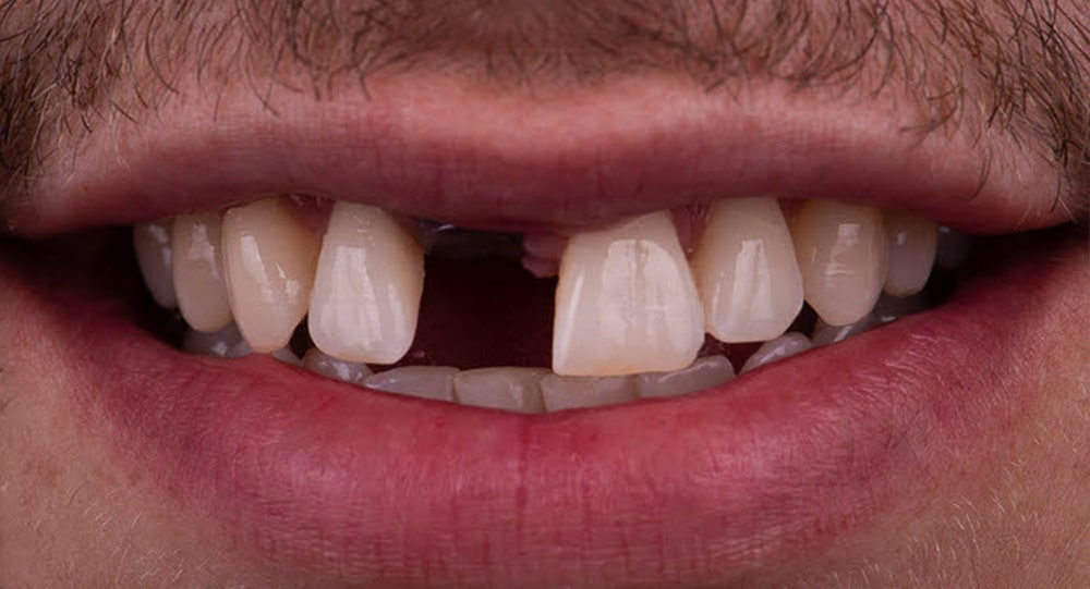 implants before Dental Implants Etobicoke