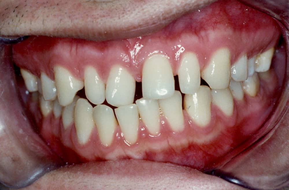 43Before After 2Faces 2 original 1 Braces Etobicoke