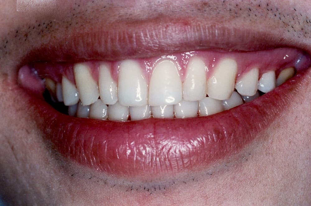43Before After 2Faces original 1 Braces Etobicoke