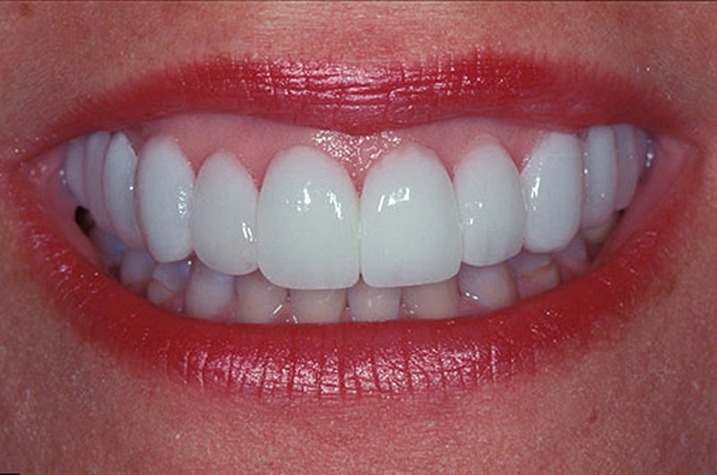 Lip Reposition smile makeover after Smile Dentist Toronto