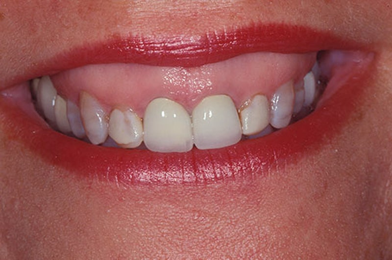 Smile Dentist Toronto 5 Smile Dentist Toronto Lip Reposition smile makeover before Smile Dentist Toronto