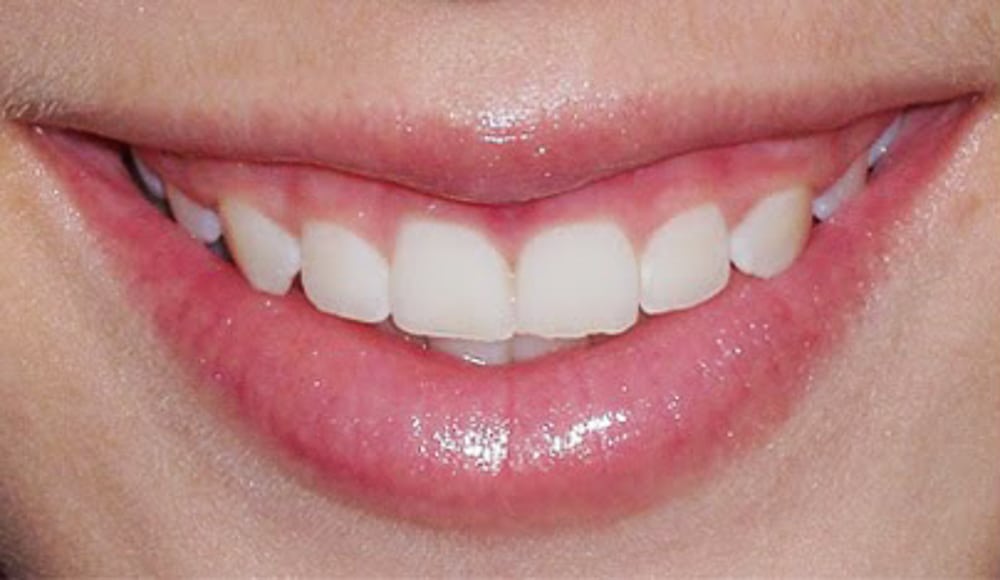 Periodontist & Laser Gum Treatment 1 Periodontist Etobicoke crown lengthening 2 original Periodontist Etobicoke