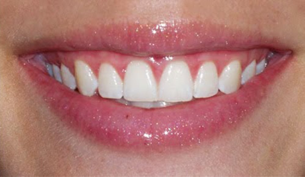 crown lengthening original Periodontist Etobicoke