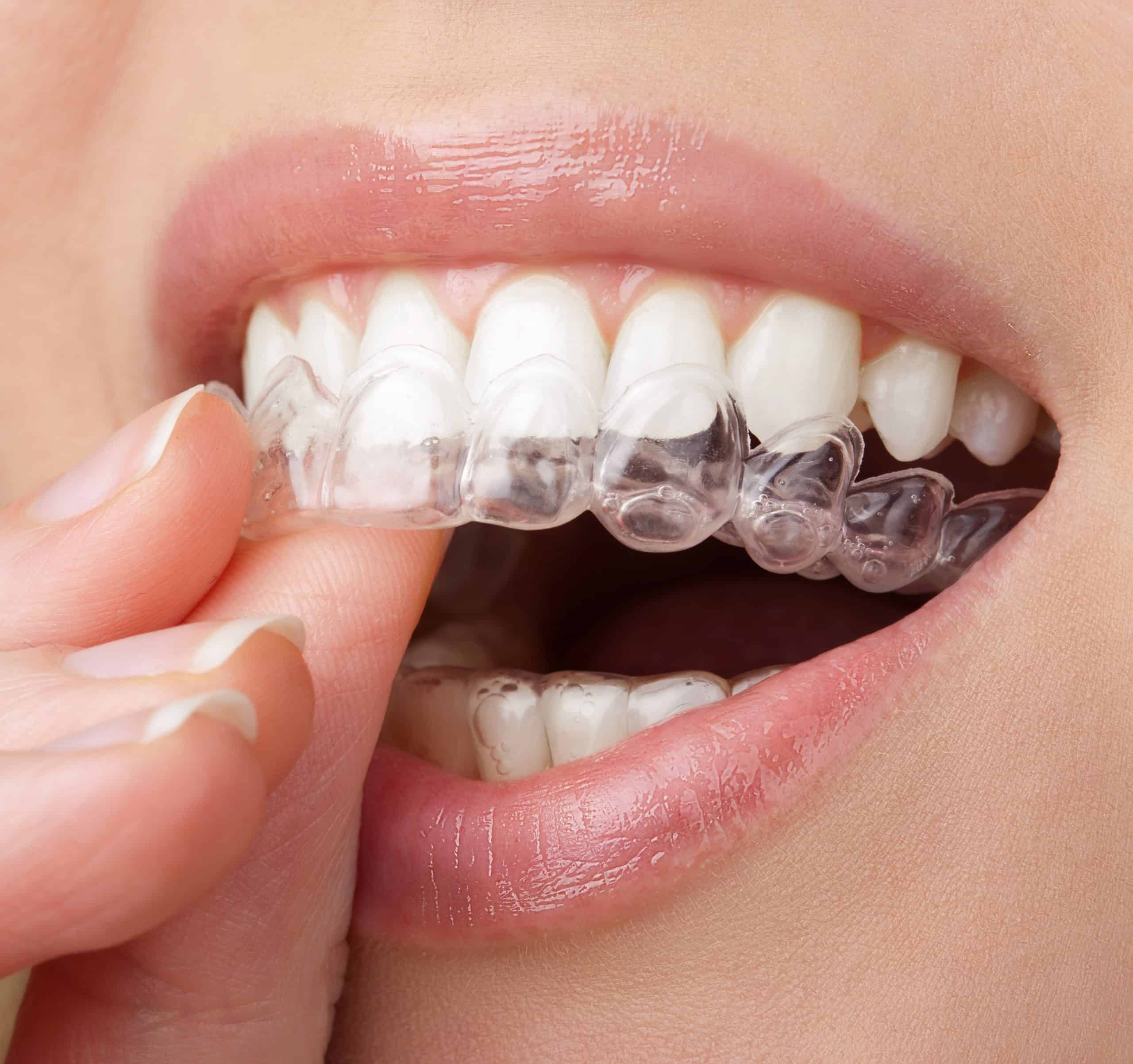 Invisalign Attachments