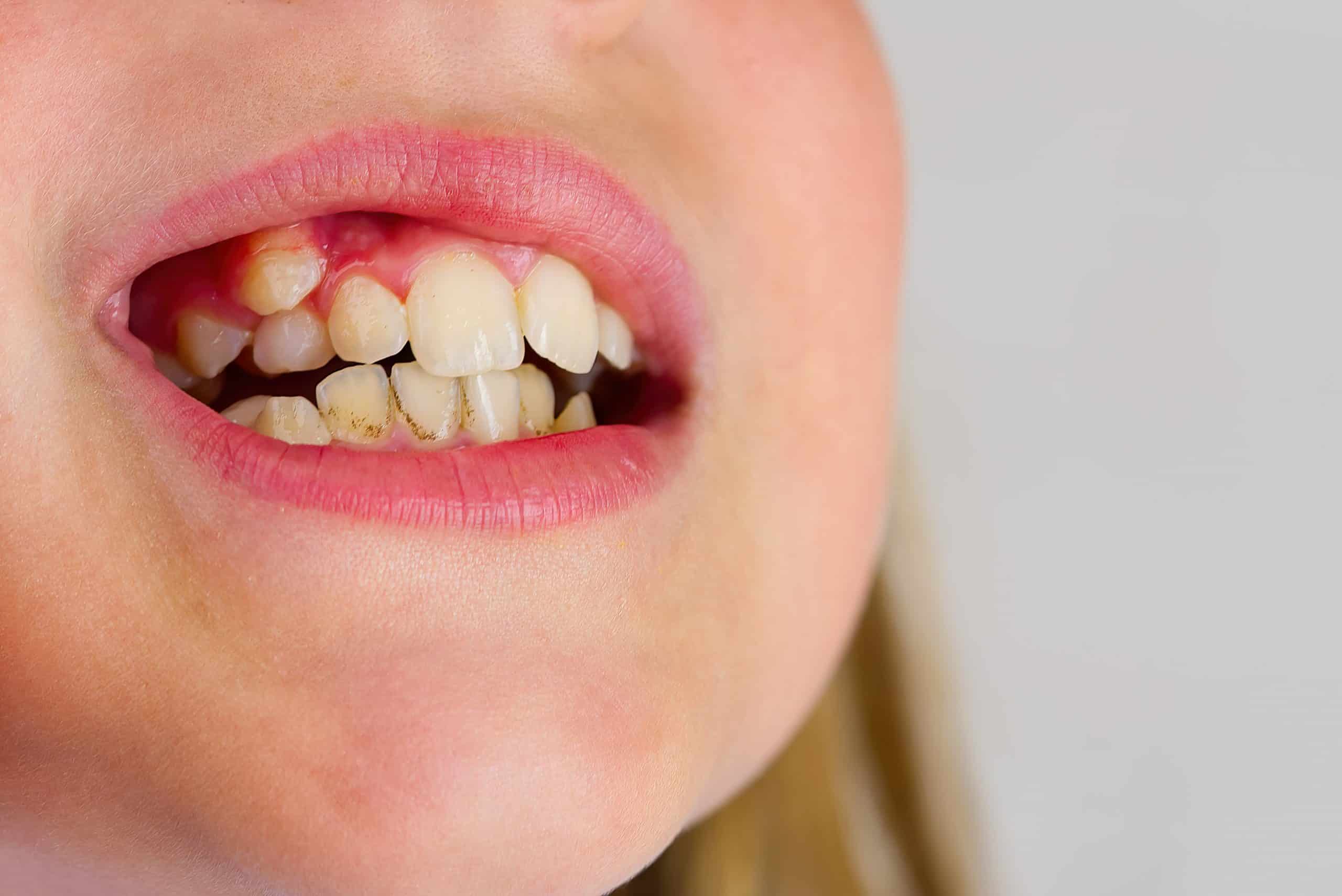 Malocclusion of Teeth