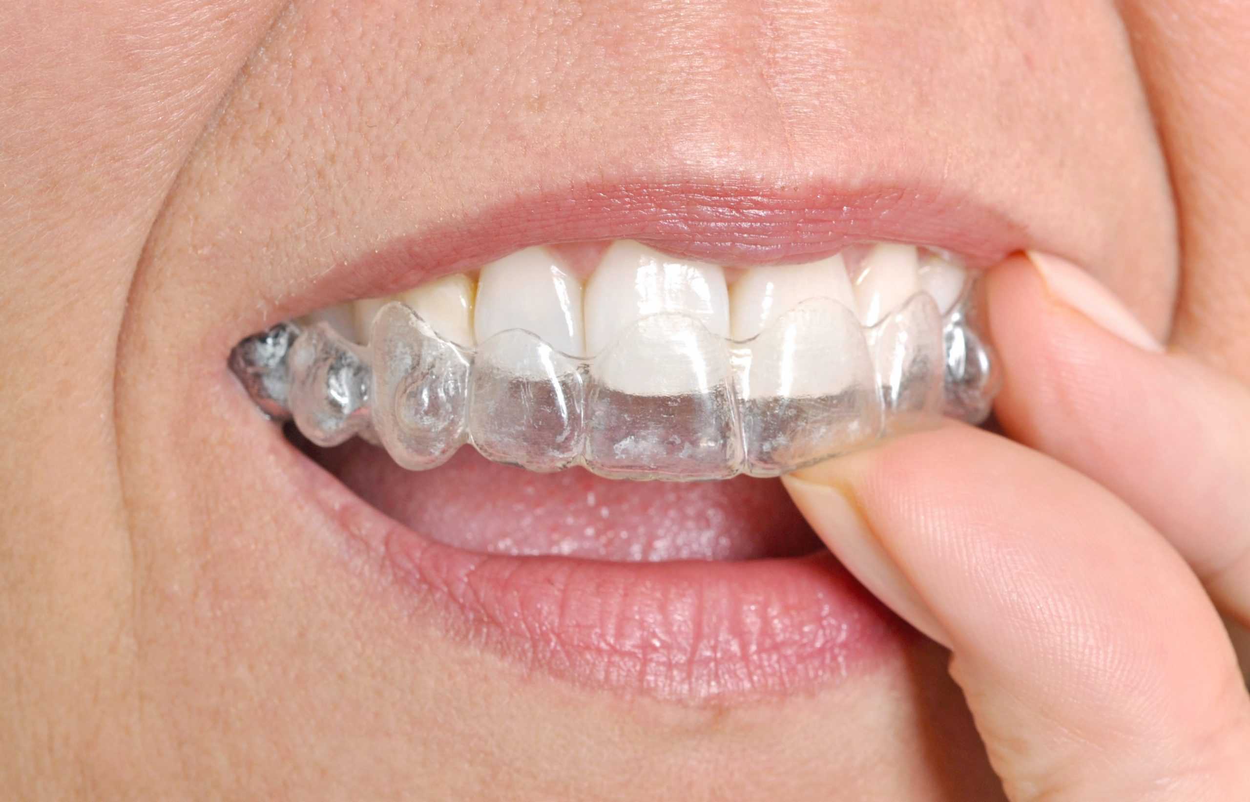 braces vs invisalign