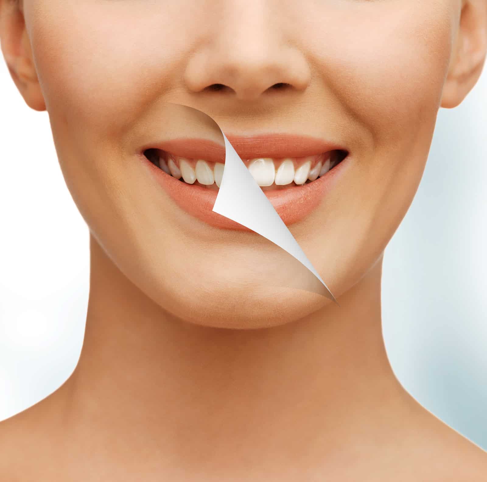 teeth-whitening Teeth Whitening Toronto | Trusted Cosmetic Dentists