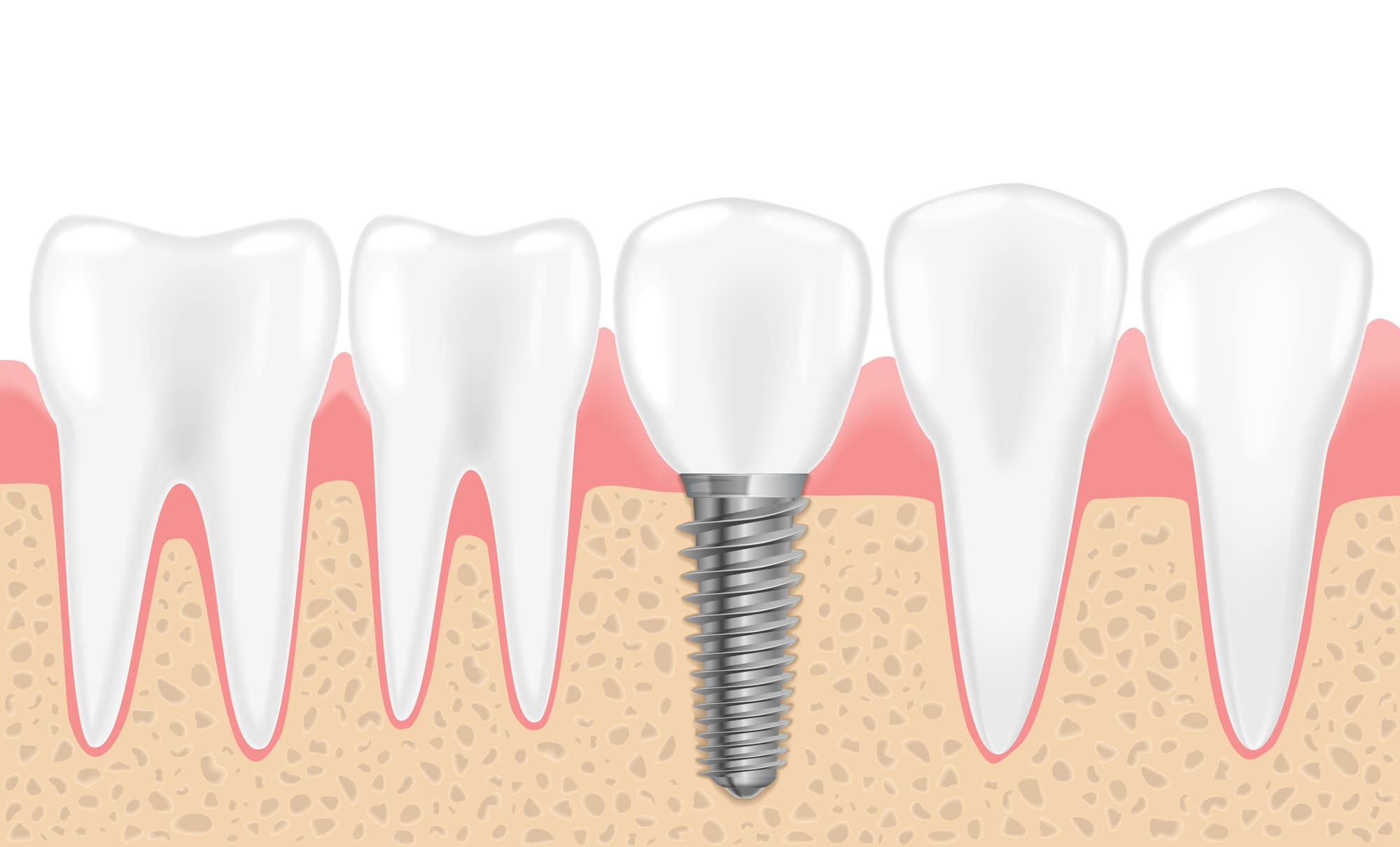 Dental implants