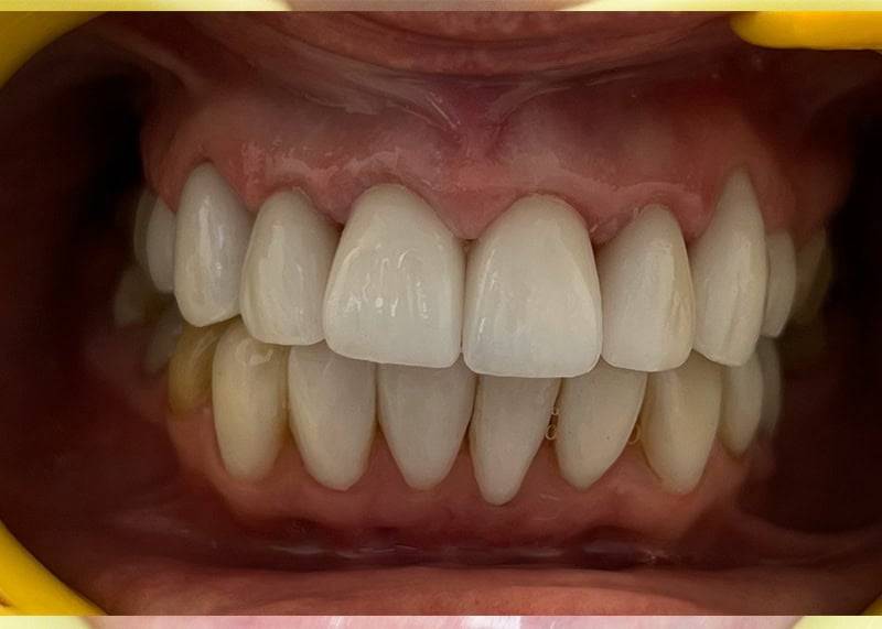 after gap fix 1 dentist etobicoke