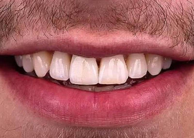 after implant 1 dentist etobicoke