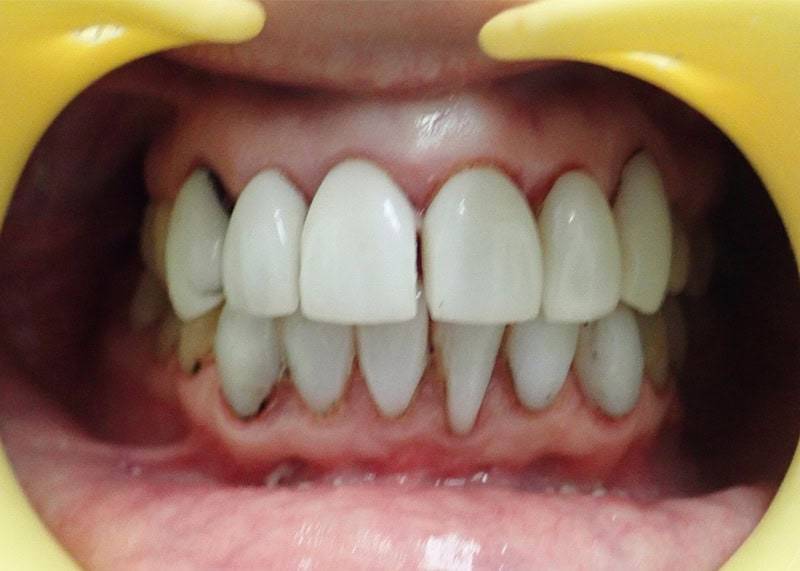 before gap fix 1 dentist etobicoke