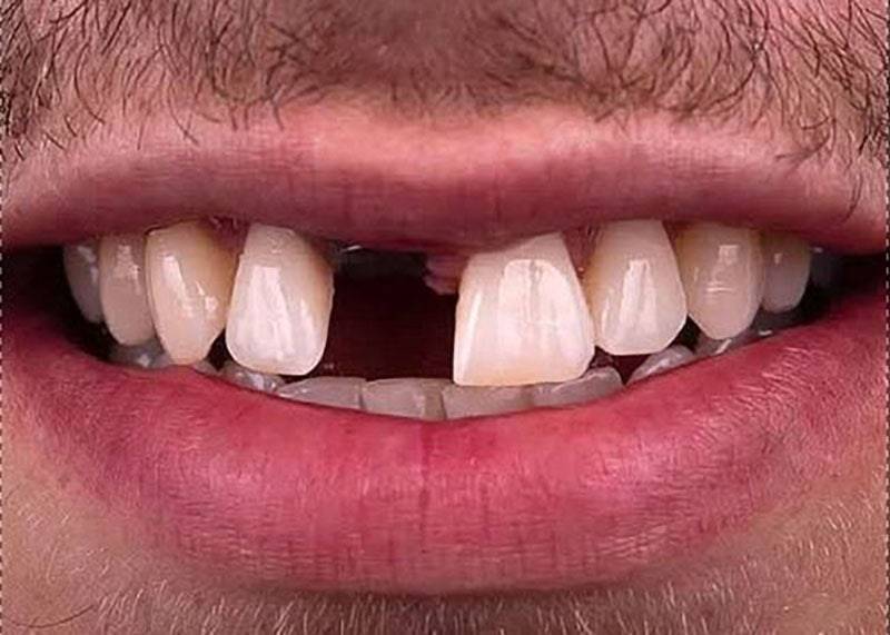 before implant 1 dentist etobicoke