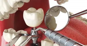 North York Dental Implants Improve Your Oral Health North York Dental Implants Improve Your Oral Health