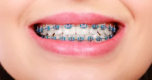 Find the Best Braces Price Toronto Find the Best Braces Price Toronto
