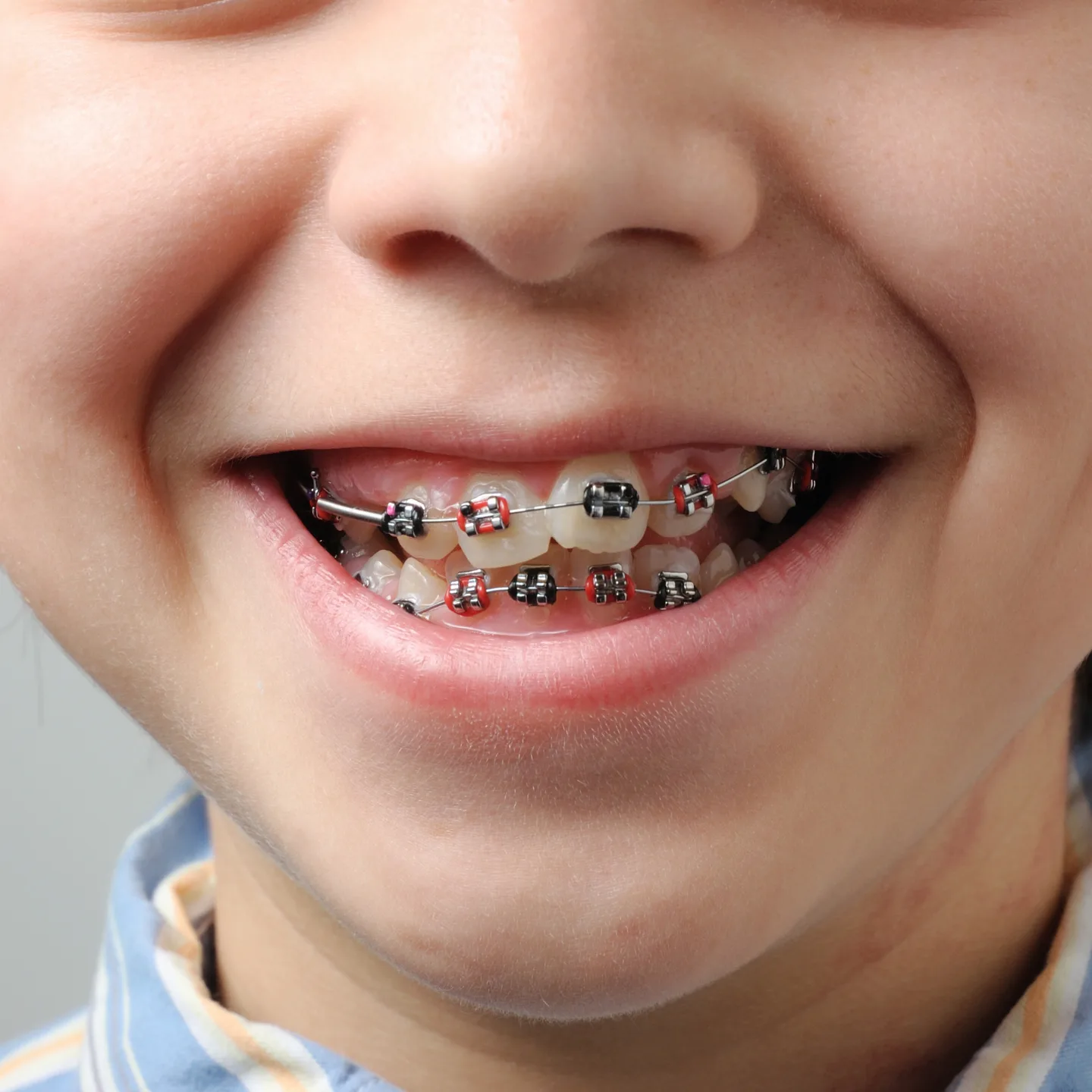 Braces for Kids Dr Savita Chaudhry