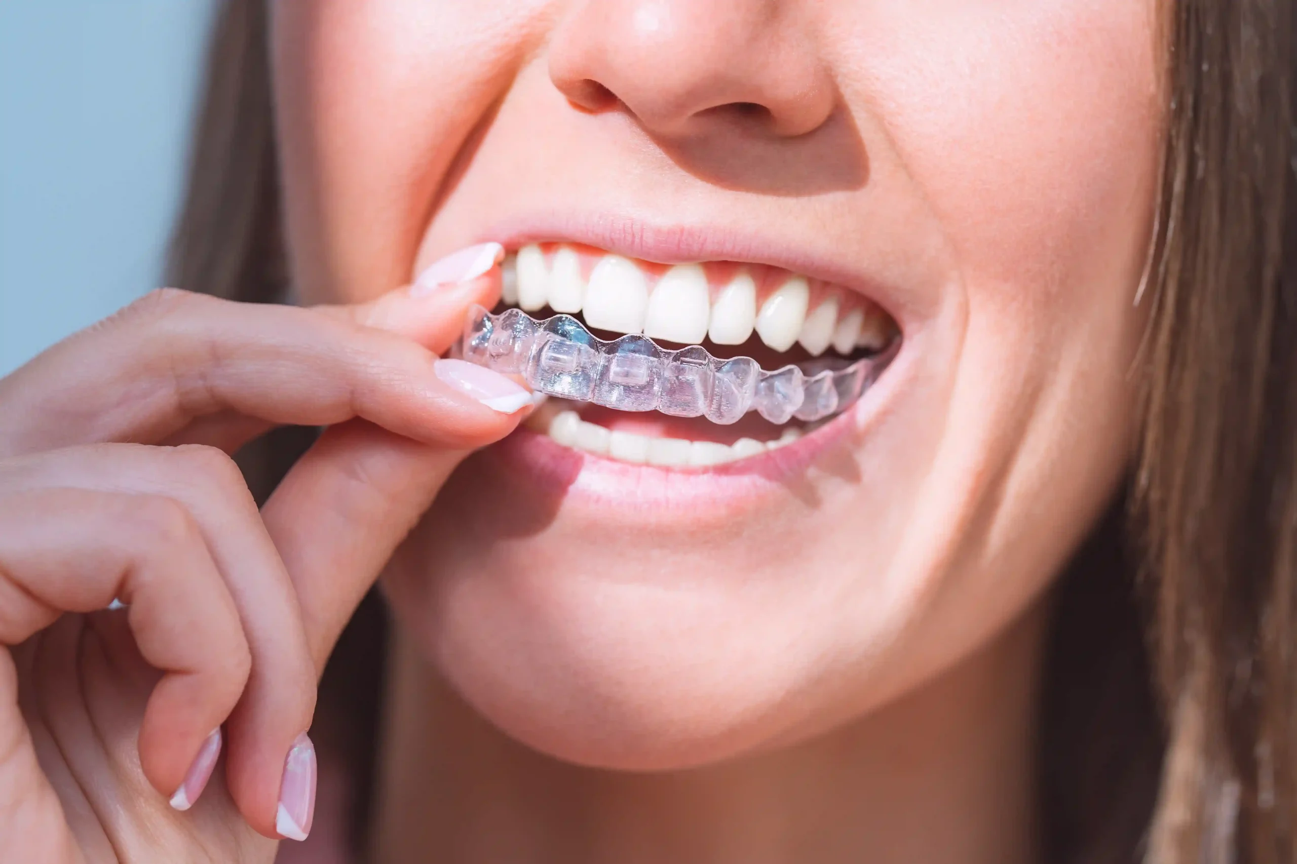 Invisalign The Clear Alternative to Braces Invisalign Etobicoke - Dr Savita Chaudhry