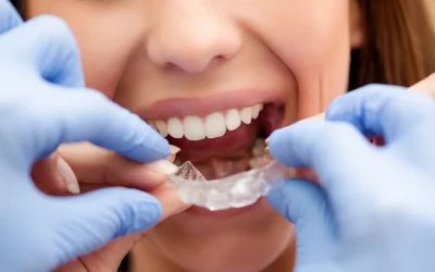 Smile Direct Club vs. Invisalign – Which Should You Choose?