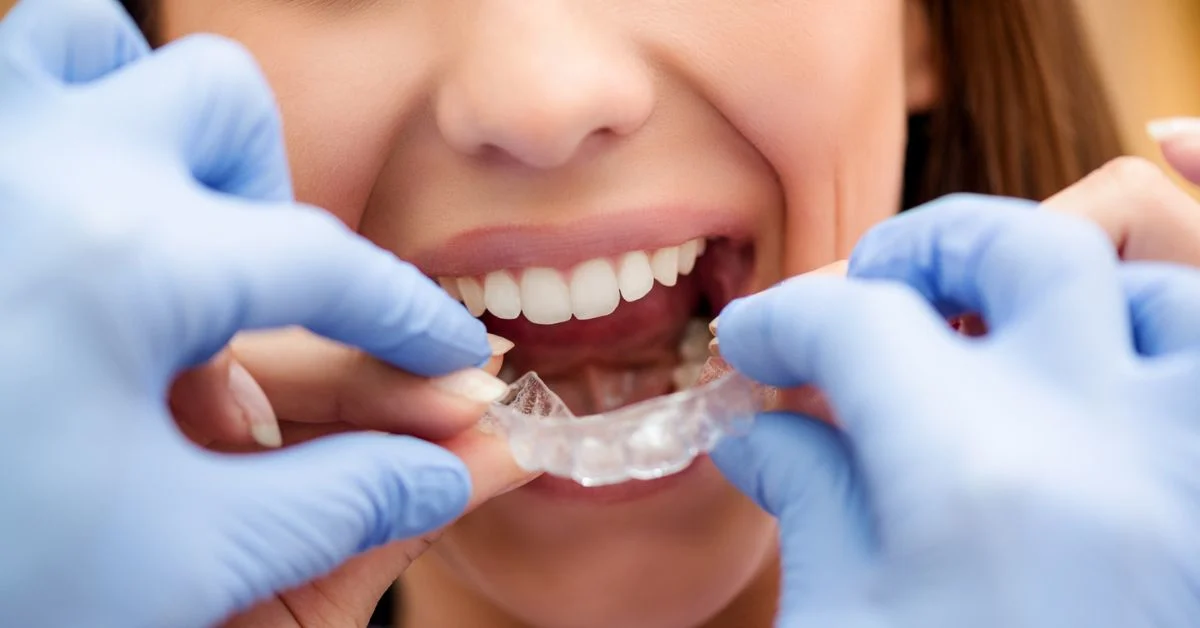 Smile Direct Club vs. Invisalign Dr Savita Chaudhry