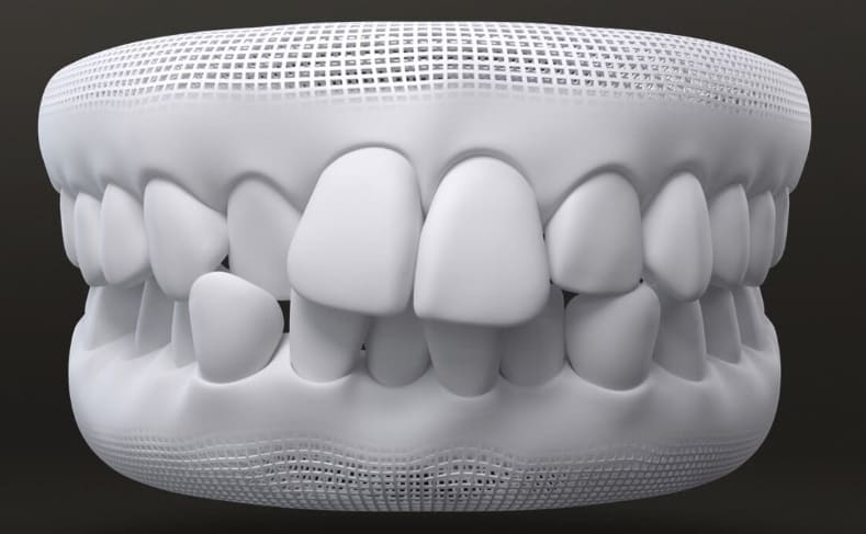 teeth crowding problem