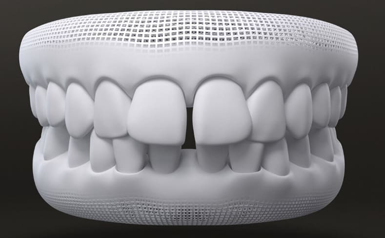 teeth crowding problem