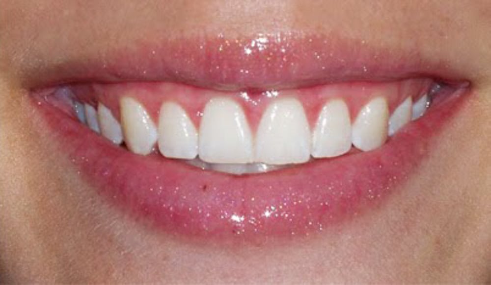 Periodontist Etobicoke | Periodontal Care Etobicoke | Laser Gum Treatment