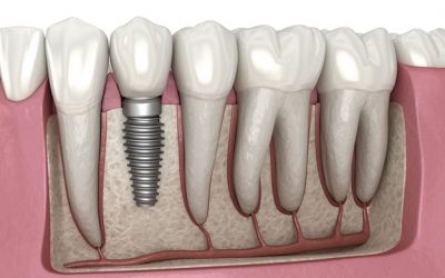 Top 9 Benefits of Dental Implants