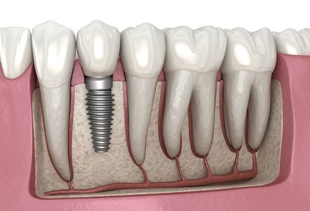 Top 9 Benefits of Dental Implants