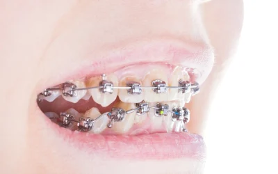 How to Fix an Underbite? Causes & Correction Methods