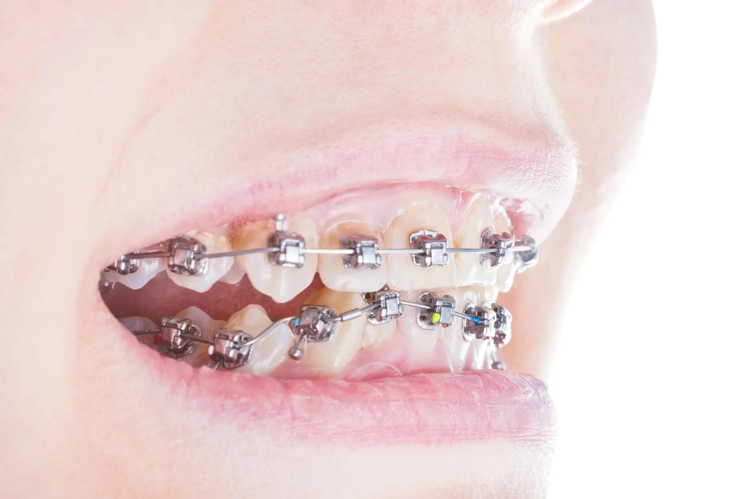 How to Fix an Underbite - Dr Savita Chaudhry