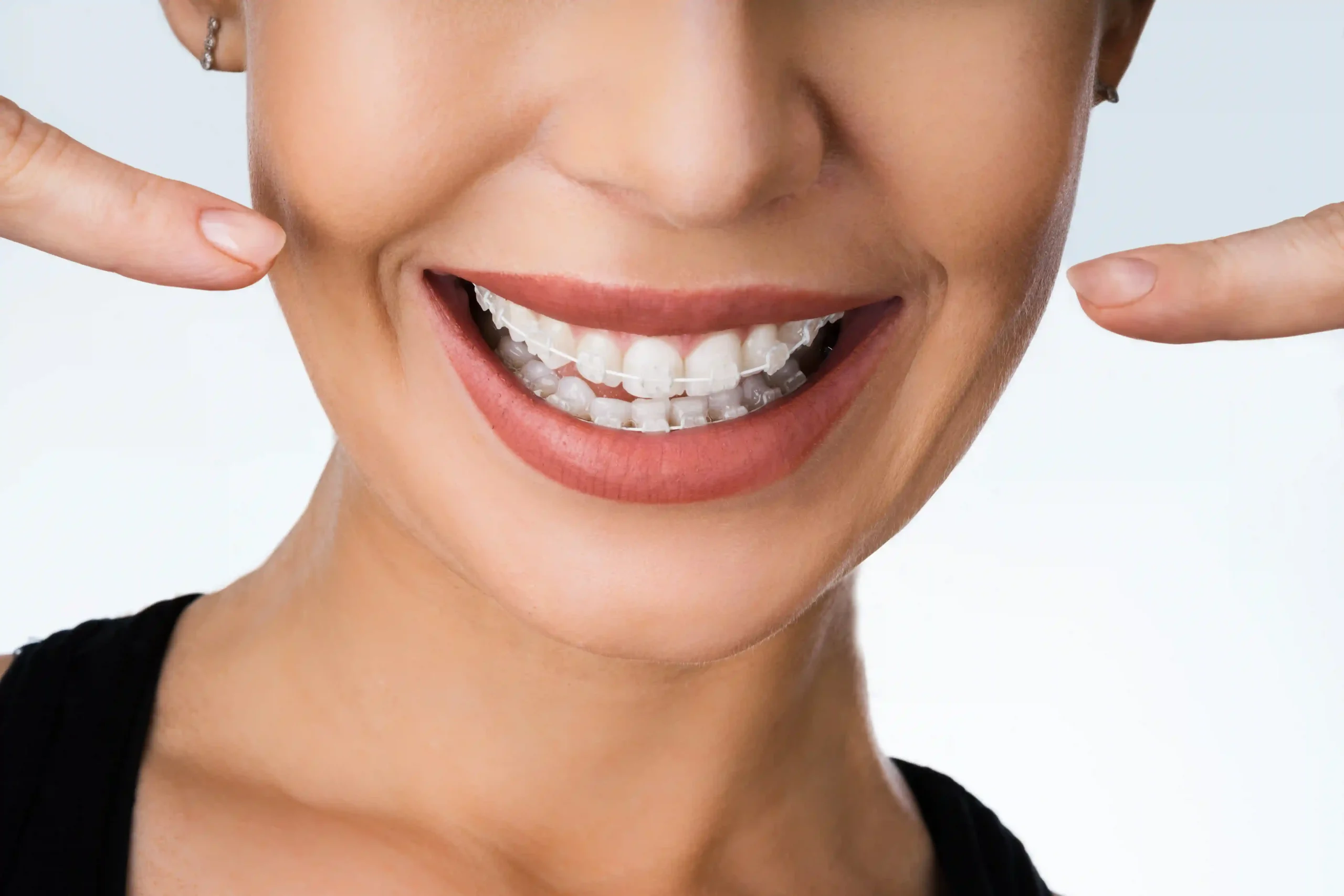 How to fix overbite teeth Buck Teeth Buck Teeth - Dr Savita Chaudhry