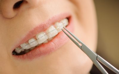 Advantages of Ceramic Braces for Adults: Why They Are a Popular Choice?