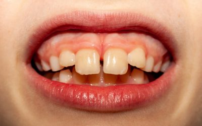 Understanding Protrusion Teeth – Types, Symptoms, and Treatment Options