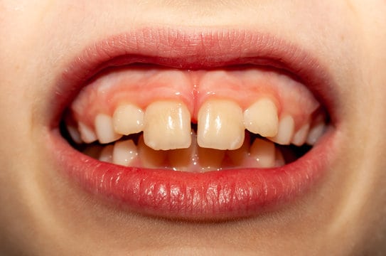 Protrusion Teeth