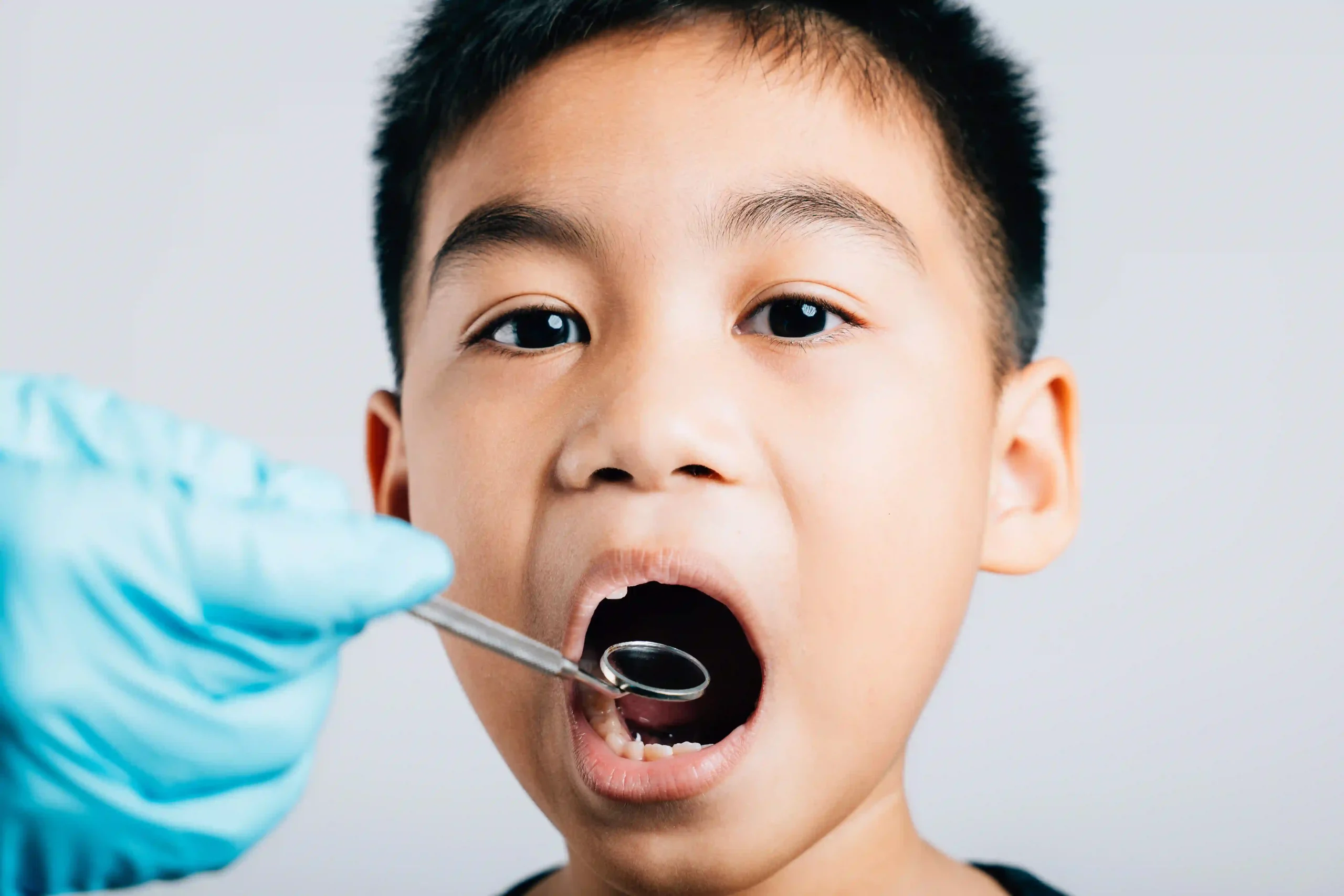 Cracked or Broken Teeth - Dr Savita Chaudhry