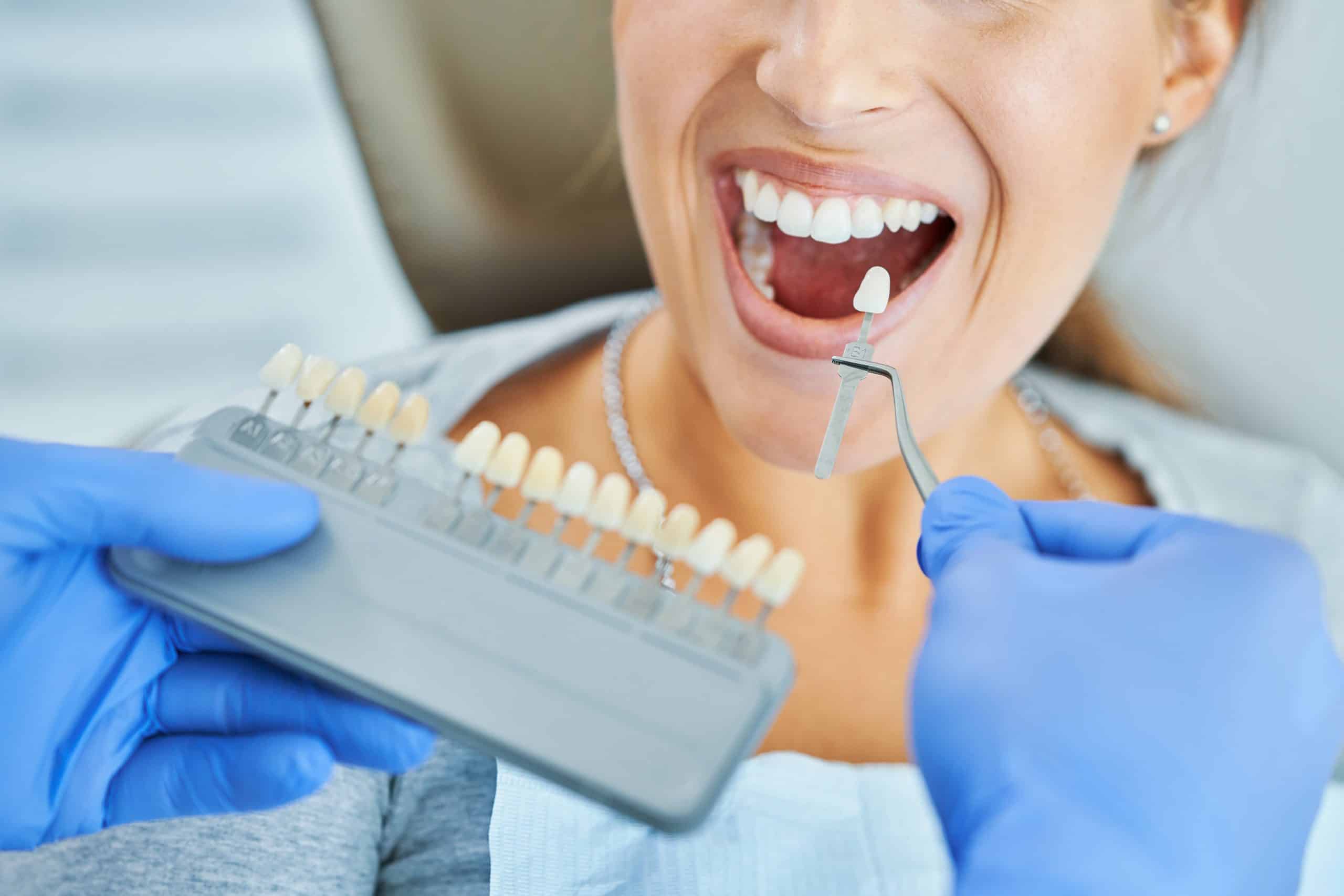 Dental Crowns cost