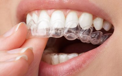 Invisalign Attachments: How They Work and What They’re Used For