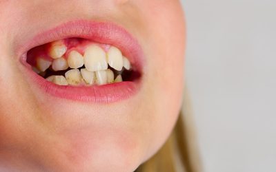 Can Braces Fix Malocclusion Problems in Teens?