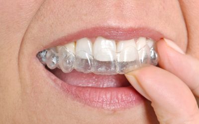 An In-Depth Difference Between Braces vs Invisalign