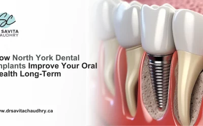 How North York Dental Implants Improve Your Oral Health Long-Term