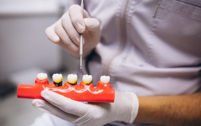 Bone Grafting for Dental Implants: Procedure, Recovery, and What to Expect