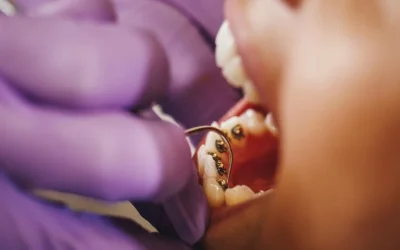 Lingual Braces: Pros & Cons, Cost, and Invisalign Comparison