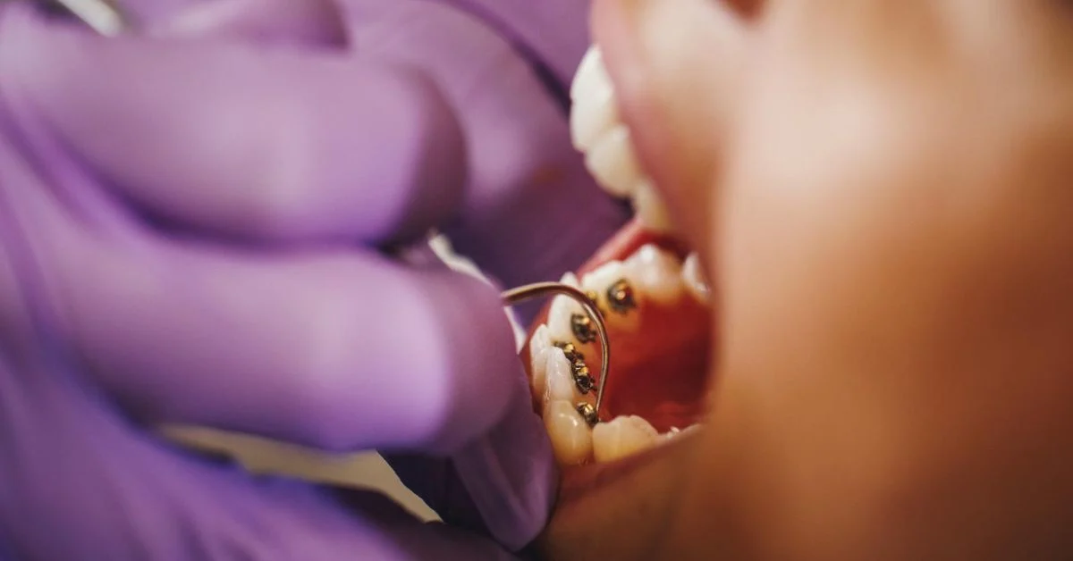 Lingual Braces - Dr Savita Chaudhry