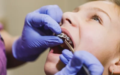 4 Signs You May Need Braces to Improve Your Smile
