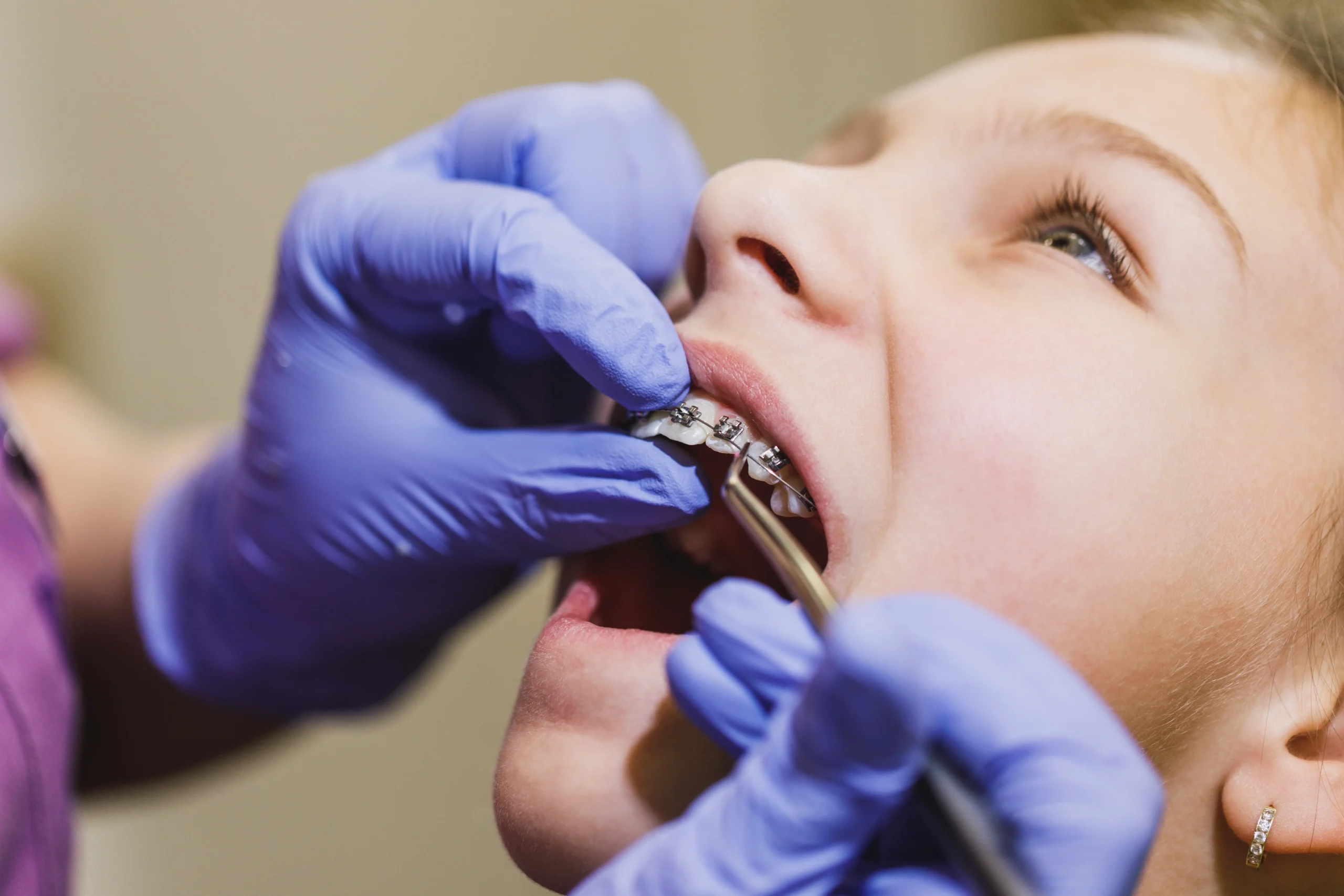4 Signs You May Need Braces to Improve Your Smile